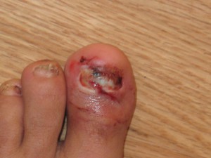 Even the RD's toes take a beating